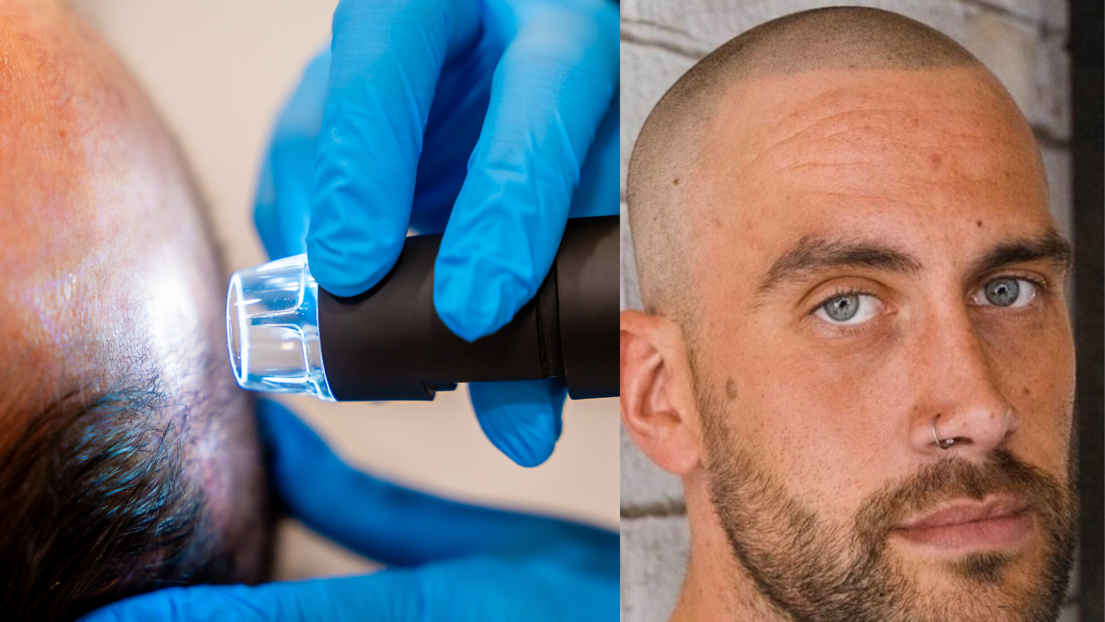 Professional SMP Treatment